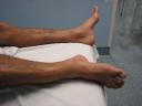 Morris's broken leg (right)